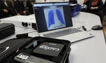 ПРООН начала внедрение ИИ для раннего выявления туберкулёза в Туркменистане